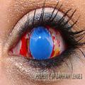 Corneal Burn